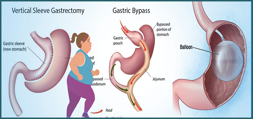 Bariatric-Surgery-Obesity