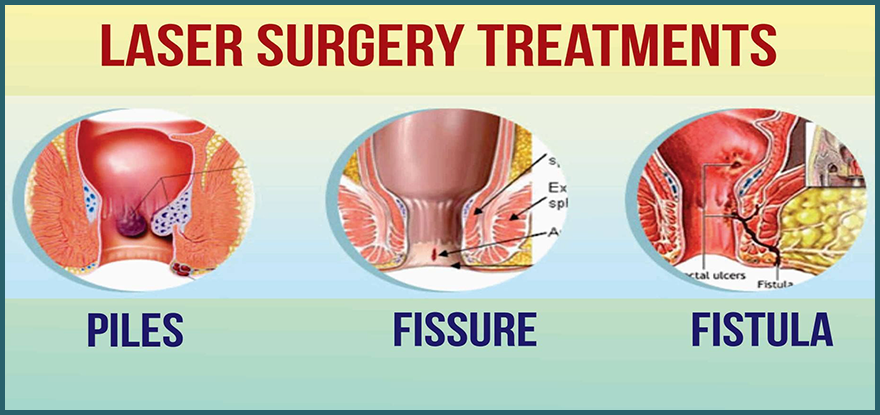 Laser-Treatment-Piles-Fistula