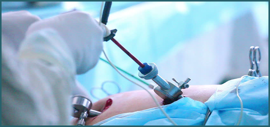 laparoscopic-surgery